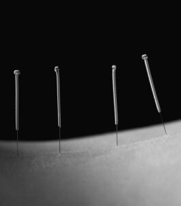 four acupuncture needles in a patient's back